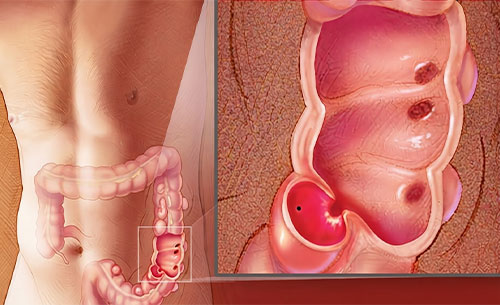 Diverticular