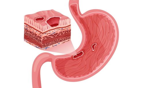 stomach ulcer.