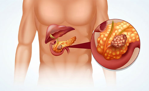 Pancreatitis symptoms, causes, and treatment