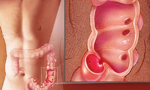 Diverticular