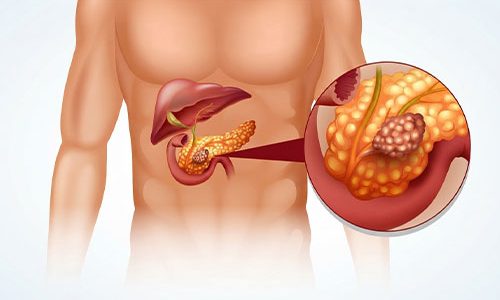 Pancreatitis symptoms, causes, and treatment