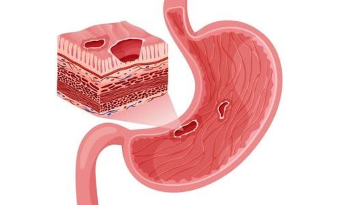stomach ulcer.